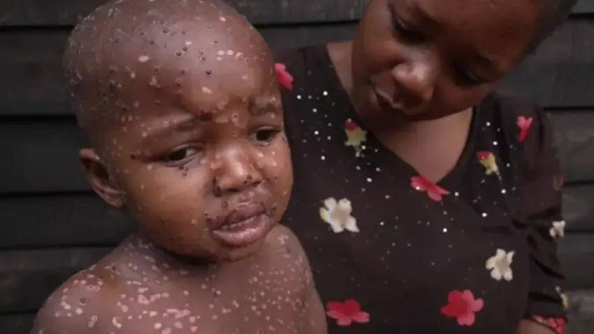 Maymun çiçeğinde son gelişme